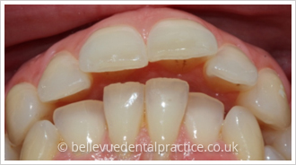 teeth alignment uk
